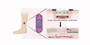 Rapid and effective healing of diabetic ulcers