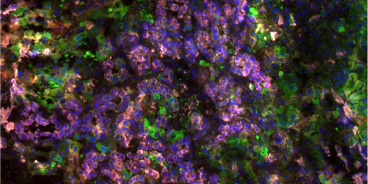 Biomarker identifies the risk of liver cancer