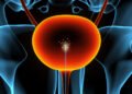 A new sensor might help find bladder cancer earlier
