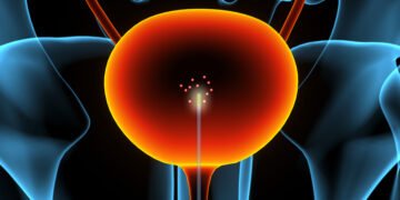 A new sensor might help find bladder cancer earlier