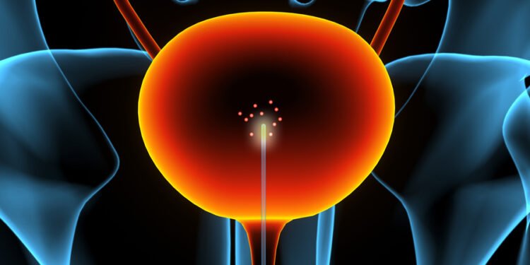 A new sensor might help find bladder cancer earlier