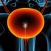 A new sensor might help find bladder cancer earlier