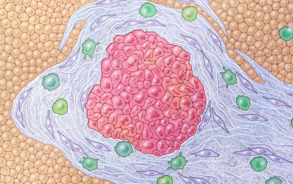 Vitamin D analog helps break down the protection of pancreatic cancer in a clinical trial.