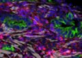 Vitamin D analog helps break down the protection of pancreatic cancer in a clinical trial.