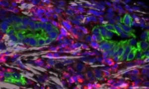 Vitamin D analog helps break down the protection of pancreatic cancer in a clinical trial.