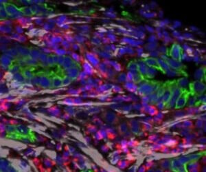 Vitamin D analog helps break down the protection of pancreatic cancer in a clinical trial.