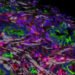Vitamin D analog helps break down the protection of pancreatic cancer in a clinical trial.