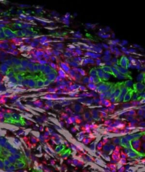 Vitamin D analog helps break down the protection of pancreatic cancer in a clinical trial.